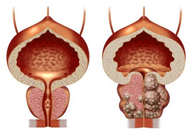 vesela prostata un prostatas adenoma