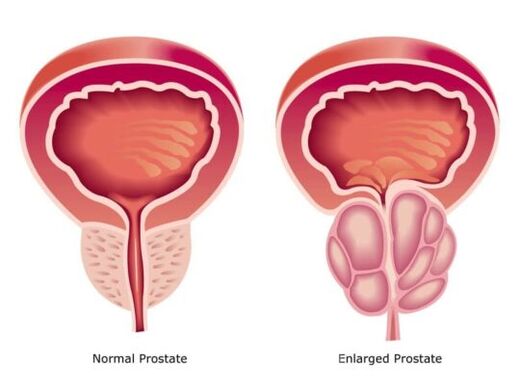 Normāla un palielināta prostata