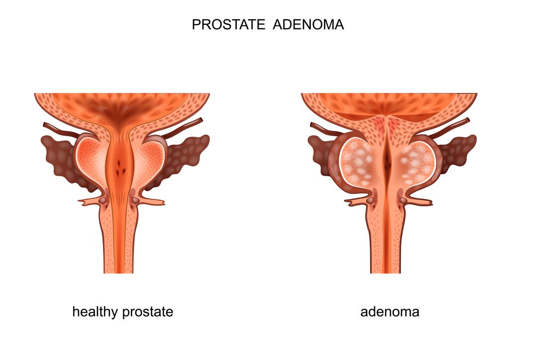 veselīga prostata un ar adenomu